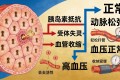 高血压不是病，是症状——90%病因隐瞒的真相