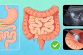 肠癌是最笨的癌症：5项风险自测+早筛方案，40岁后必看